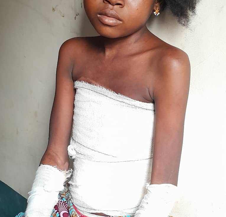 SOS pour Aïssatou Madina, victime de brûlure alors qu’elle réchauffait le petit déjeuner pour aller à l’école