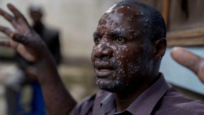 Épidémie MPox en RDC: l’OMS pourrait déclencher une alerte internationale face à son ampleur